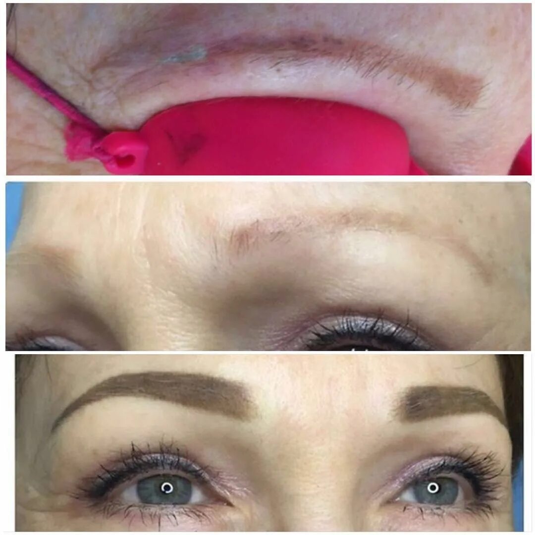 Удаление перманентного макияжа лазером. Удаление перманентного макияжа бровей лазером. Отек после перманентного макияжа бровей. Отек после лазерного удаления. Отек после лазерного удаления.