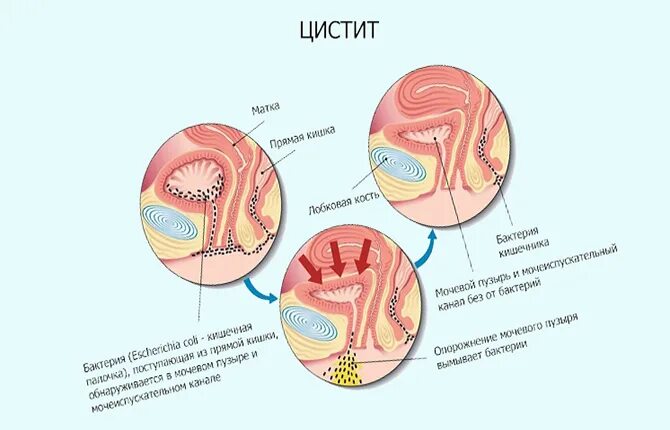 Боль внизу живота при мочеиспускании у женщин. Цистит у женщин.