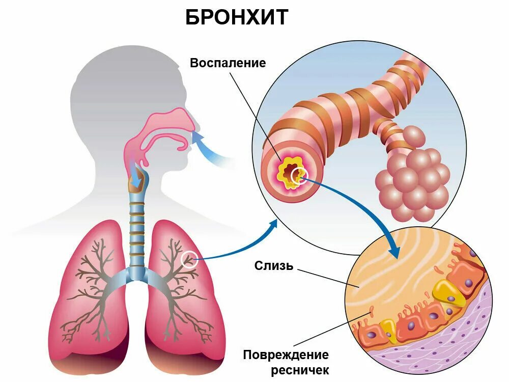 Слизь в организме причины. Поражение бронхов острый бронхит. Хронический бронхит симптомы дыхание. Острый и хронический бронхит.