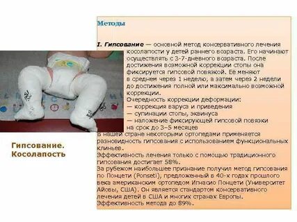 Гипс сколько месяцев