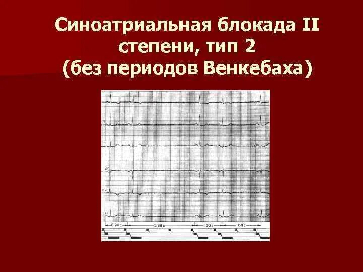 Са блокада 1 степени. Са-блокада II степени, Тип i. Синоатриальная блокада 2 степени на ЭКГ. Блокада са узла 2 степени. Са блокада II степени II типа.