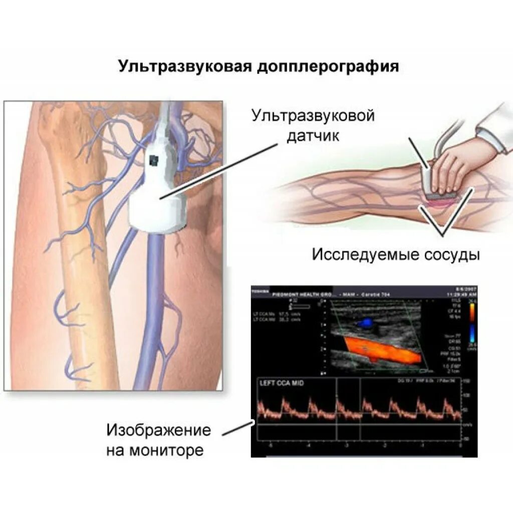 Как называется узи вен. Ультразвуковая допплерография артерий нижних конечностей. Допплеровское исследование сосудов нижних конечностей. Ультразвуковая допплерография сосудов (артерий) нижних конечностей. Дуплексное сканирование сосудов нижних конечностей результат.