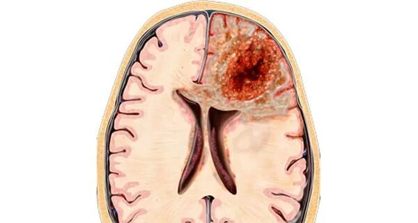 Глиобластома мозга симптомы. Глиобластома головного мозга. Опухоль головного мозга глиобластома 4. Злокачественная глиобластома головного мозга снимок.