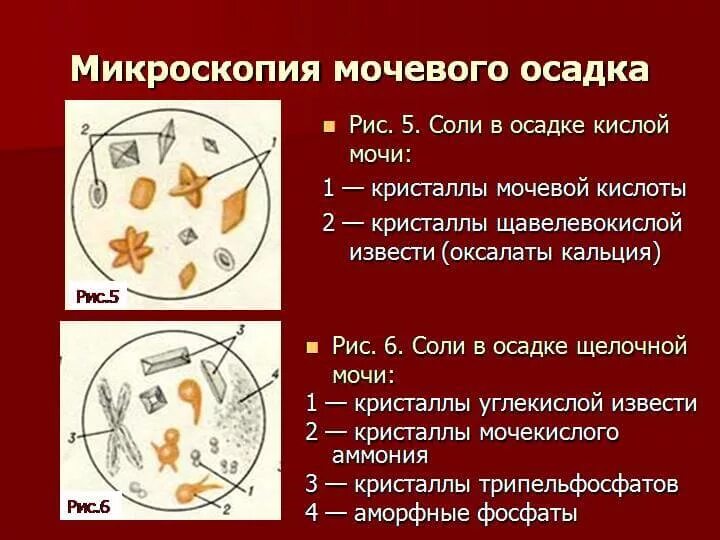 Оксалат кальция в моче повышен. Микроскопия мочи Кристаллы оксалаты. Соли в моче. Кристаллы в осадке мочи. Оли в моче микроскопия.