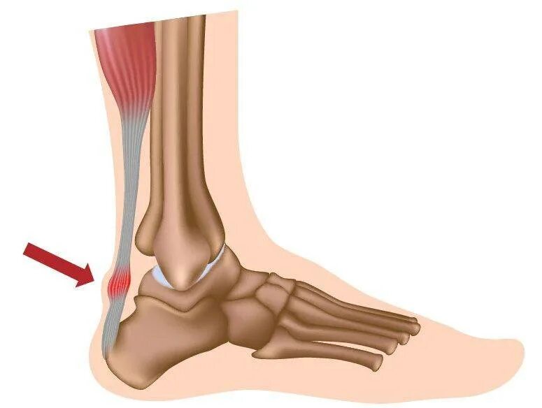 Тендинит ахиллова сухожилия. Танзенит ахилового сухожилия. Воспаление ахиллова сухожилия. Теедит ахиллова сухожилия.
