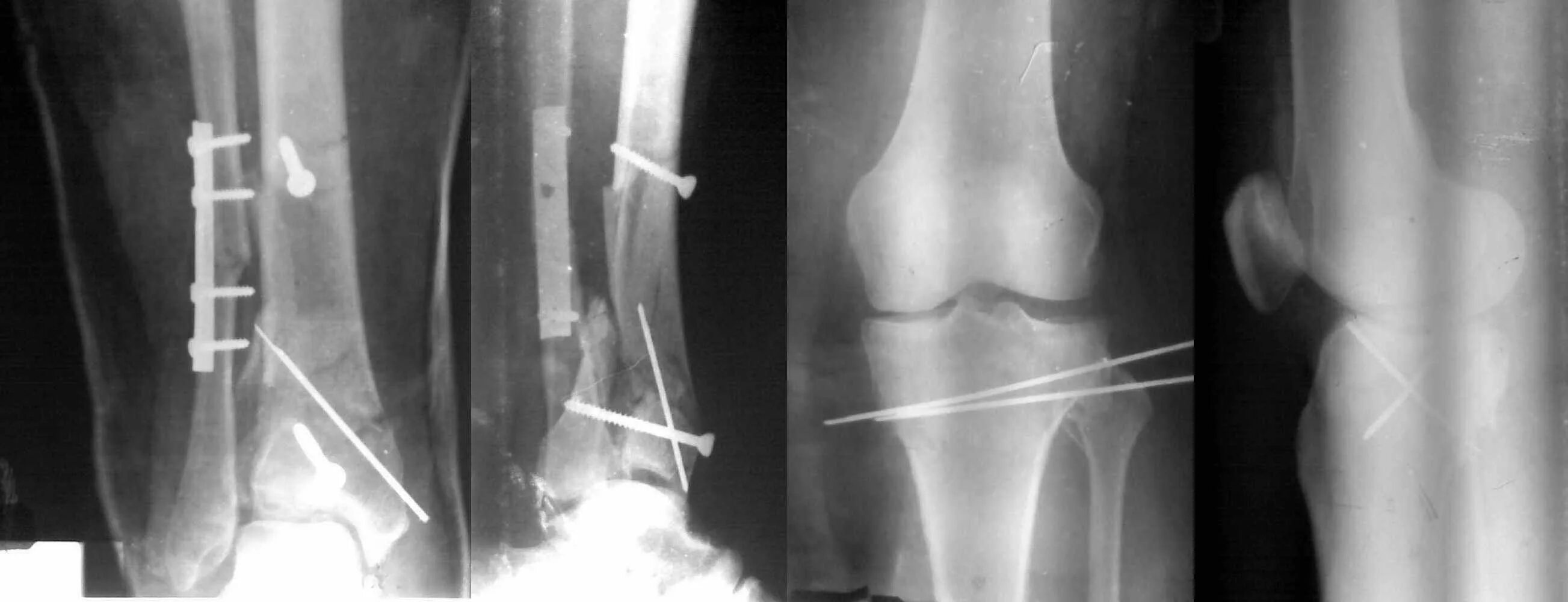 берцовая кость перелом. как выглядит перелом голени. перелом малоберцовой кости рентген. снимок вывихнутой ноги. костная мозоль после перелома большеберцовой кости на рентгене.
