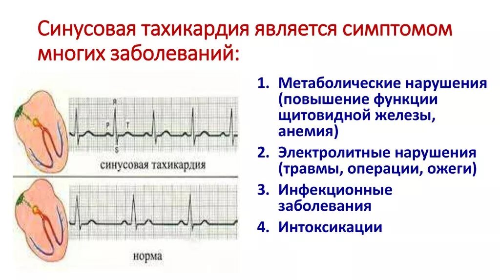 Учащенное сердцебиение при нагрузках. Синусовая тахикардия причины. Синусная тахикардия ЭКГ. ЭКГ синусовая тахикардия пленка. ЭКГ проявления синусовой тахикардии.