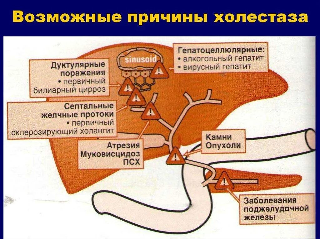 Как желчный пузырь влияет на печень. Причинам гепатоцеллюлярного холестаза. Лабораторные проявления синдрома холестаза. Внутрипеченочные и Внепеченочные желчные пути. Причины развития холестаза.