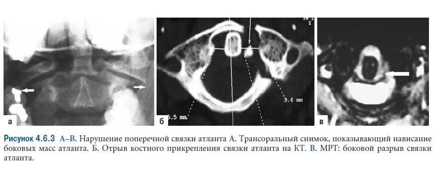 Атлант кт. Подвывих атланта на мрт. ротационный подвывих атланта с1 кт. ротационный подвывих атланта мрт. ротационный подвывих атланта на кт.