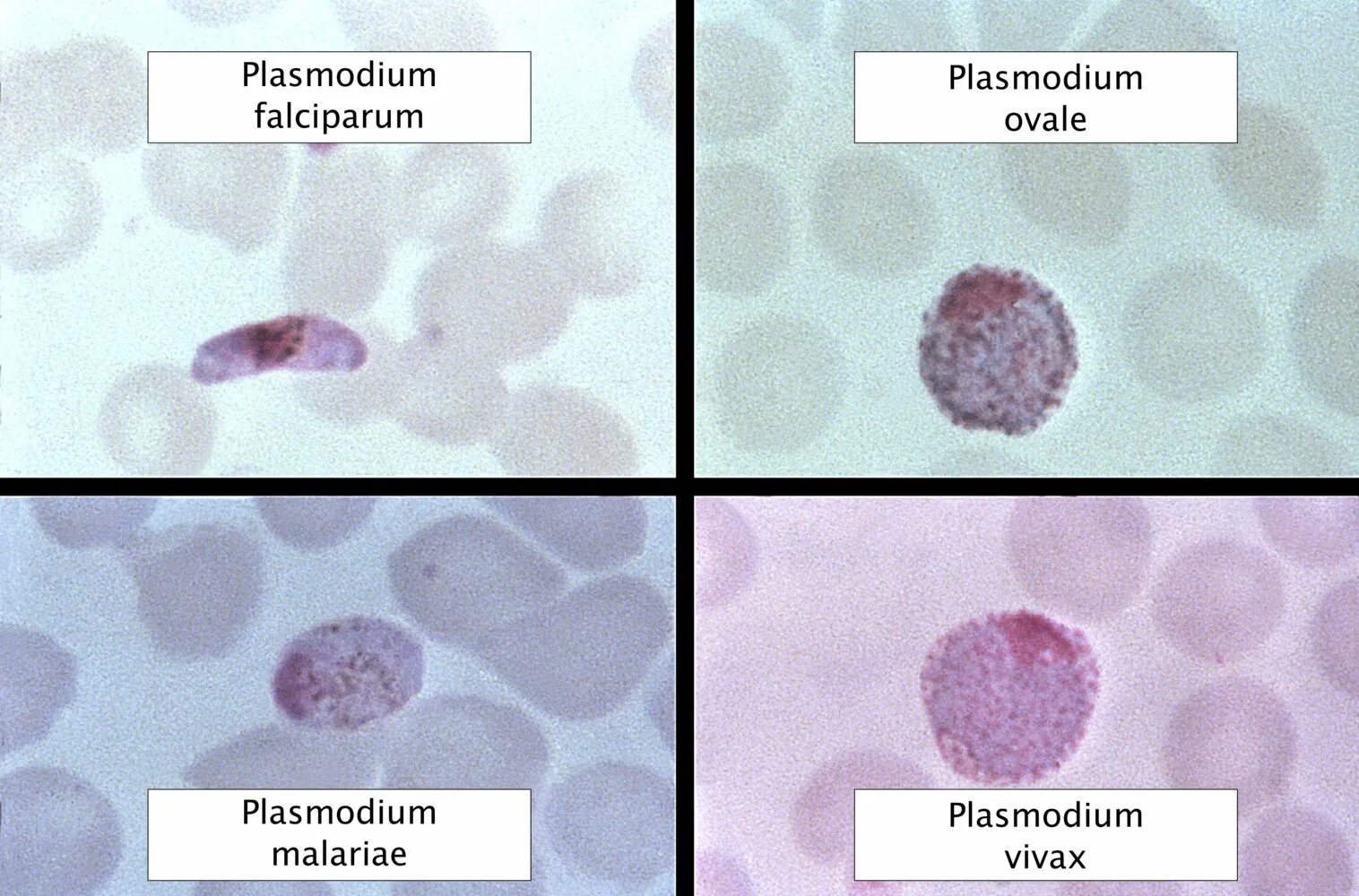 Плазмодий Вивакс под микроскопом. Плазмодий Вивакс заболевание. Малярийный плазмодий Вивакс. Plasmodium falciparum это возбудитель.
