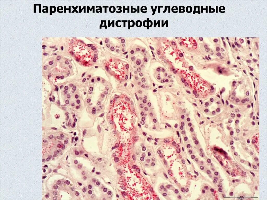 Паренхиматозные углеводные дистрофии патанатомия. Паренхиматозные углеводные дистрофии патологическая анатомия. Углеводная дистрофия эпителия почечных канальцев. Паренхиматозные углеводные дистрофии микропрепарат.