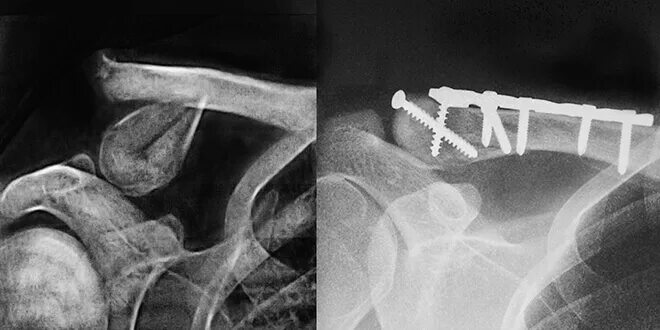 Винтообразный перелом ключицы. Вколоченный перелом ключицы. Перелом ключицы после операции. Экстрамедуллярный остеосинтез ключицы. Винтообразный перелом ключицы.