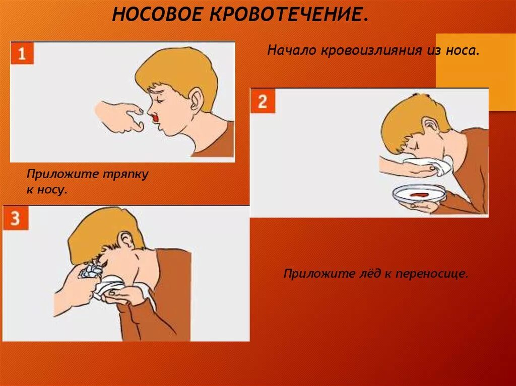 При кровотечении из носа. Причины носового кровотечения. Оказание помощи при кровотечении из носа.