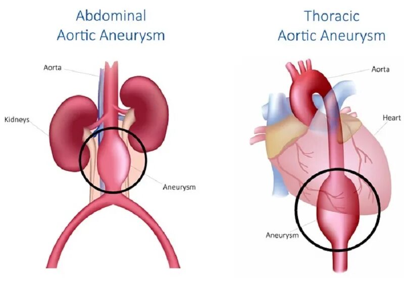 Аневризма сердца что это такое симптомы. Аневризма аорты сердца. Аневризматическое расширение брюшного отдела аорты. Аневризмы грудного отдела аорты. Аневризмы грудной аорты этиология.