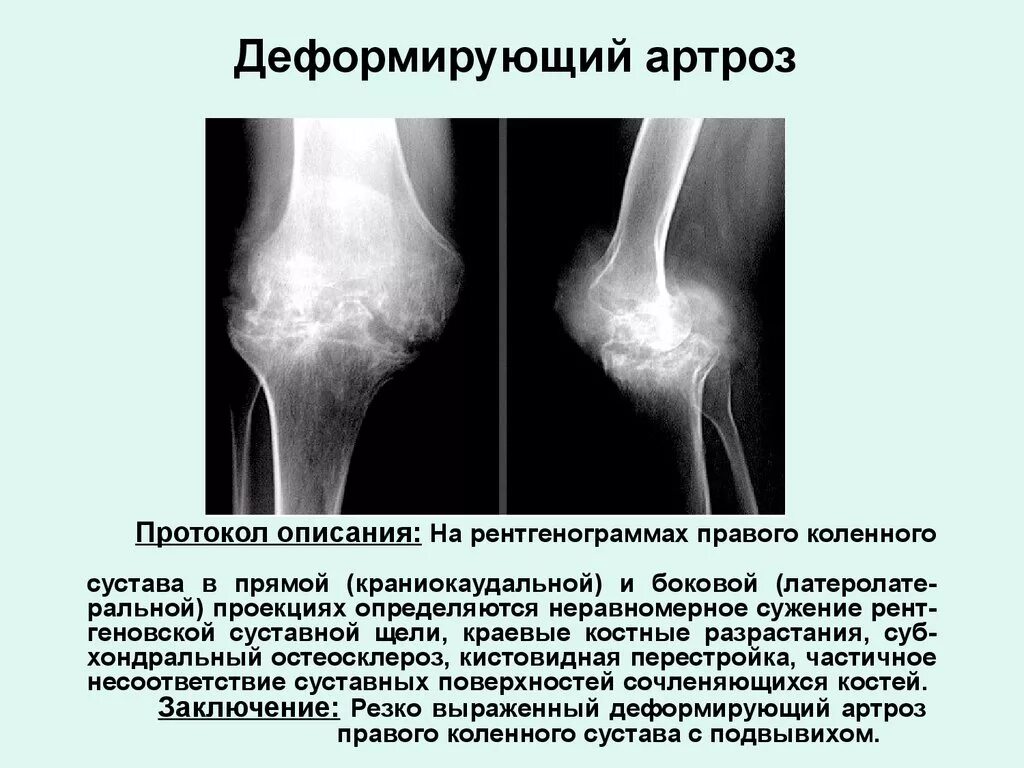 Деформирующий артроз коленного сустава рентгенограмма. Гонартроз коленного сустава стадии. Деформирующий остеоартроз рентген. Деформирующий гонартроз рентген. Сужение коленных суставов