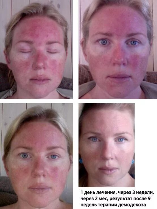 Народные средства от угревой сыпи. Народные средства от акне. Лечит какое лицо. Розацеа пастуло-парпуллезная. Лечит какое лицо.