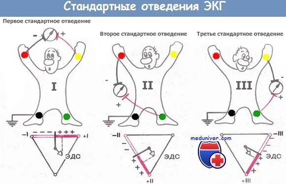 Как правильно снять кардиограмму Как делают экг: техника наложения и снятия электродов, как снимают и накладывают