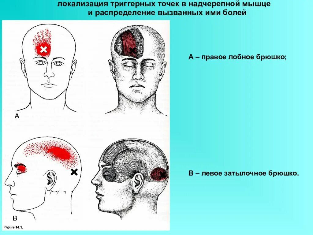 Сильно болит верхний. Головная боль локализация. Боль в голове. Головная боль схема. Болит голова внутри черепа.