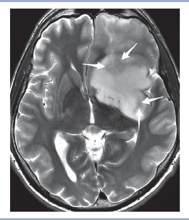 Глиома лечение. Анапластическая астроцитома кт. Астроцитома 4 Grey. Злокачественная астроцитома.