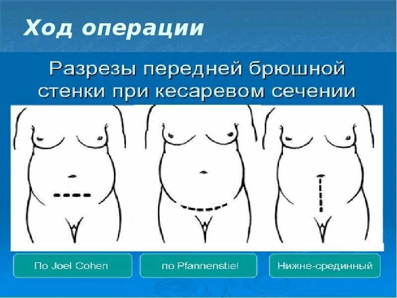 Как называется разрез при родах. Разрезы при кесаревом сечении. классификация кесарева сечения. корпоральное кесарево сечение. разрез при кесарево сечение.