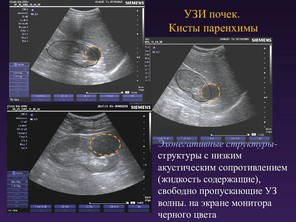 Киста на печени чем опасна у женщины. Киста паренхимы почки УЗИ. Солитарная киста почки УЗИ. Паренхиматозная киста почки.