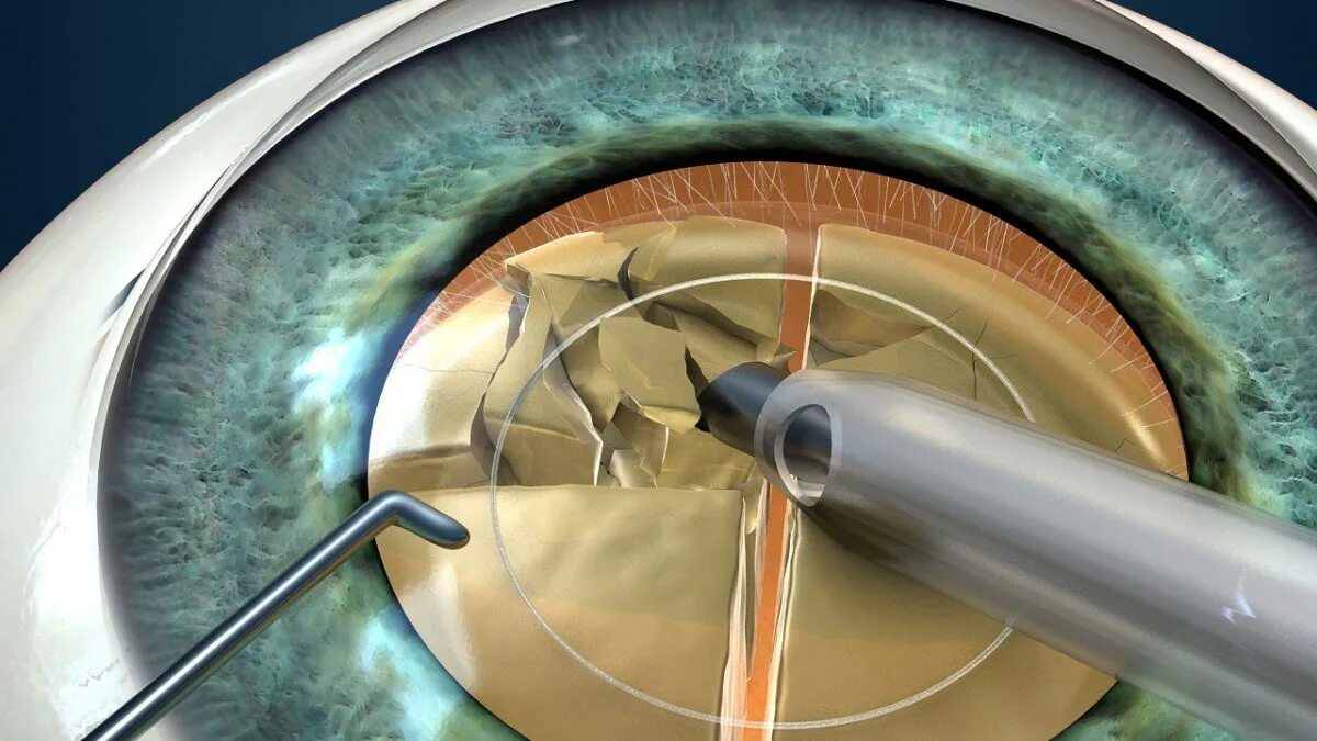 Операция катаракта замена хрусталика отзывы. Ультразвуковая факоэмульсификация катаракты. Лазерная факоэмульсификация катаракты. Бесшовная ультразвуковая факоэмульсификация. Экстракция катаракты операция.