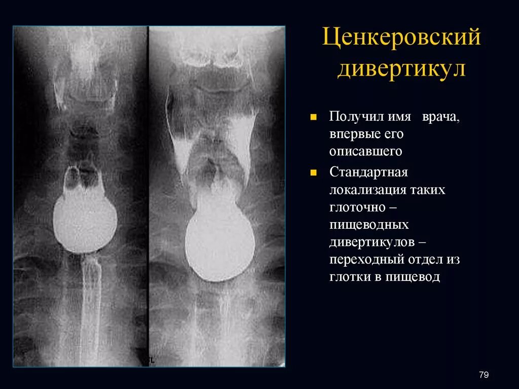 Локализация пищевода. Гипофарингеальный дивертикул Ценкера. Ценкеровский (глоточно-пищеводный) дивертикул. Локализация дивертикулов пищевода. Ценкеровский дивертикул рентген.