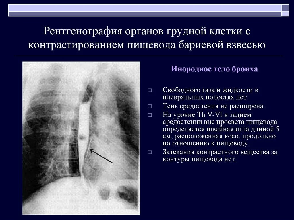 Тело пищевода. Стеноз пищевода рентгенограмма. Сужение просвета пищевода на рентгене. Инородное тело пищевода рентген снимки. Склеродермия пищевода рентген.