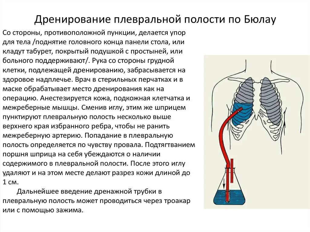 Лечение плевральной полости. Дренирование Бюлау техника плевральной полости. Дренаж плевральной полости Бюлау. Дренирование плевральной полости метод Бюлау. Дренирование плевры по Бюлау.