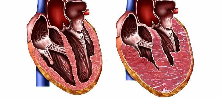 Заболевания левого желудочка. Эксцентрическая гипертрофия миокарда. Гипертрофированное сердце. Спортивное сердце. Сердце спортсмена.