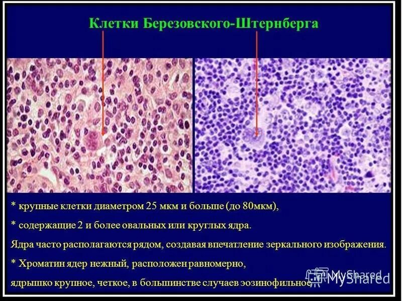 Лимфомы тесты