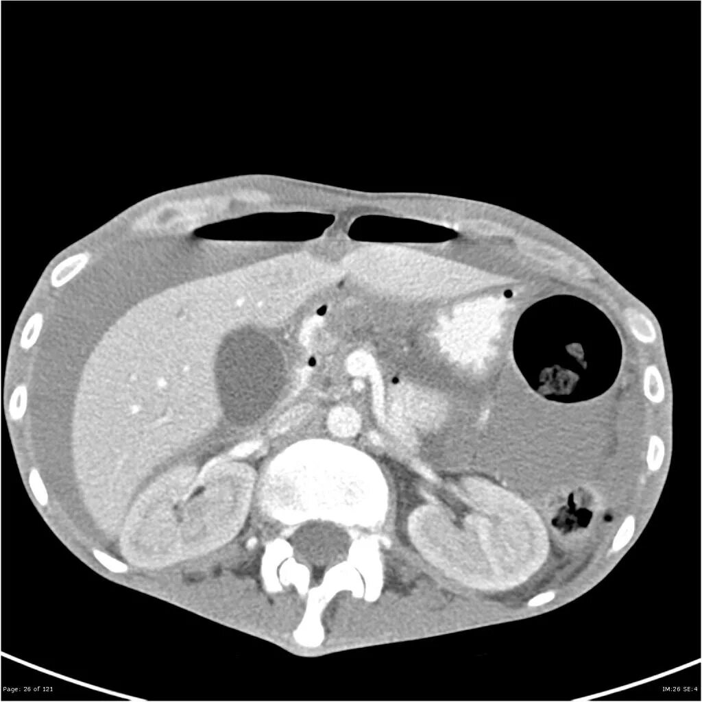 Перфоративная язва желудка кт. Перфорация язвы желудка на кт. Кт при перфорации язвы желудка. Язва кт