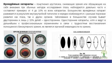 Гены катаракты