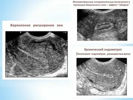 Эндометрий 4 мм форум