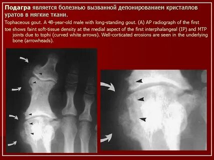 Рентгенологические признаки подагры