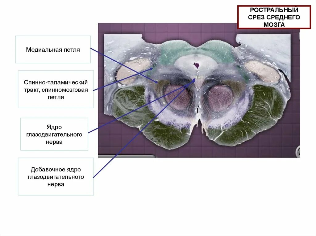 Срез среднего мозга. Срез ствола мозга. Срез среднего мозга с ядрами. Глазодвигательные ядра среднего мозга.