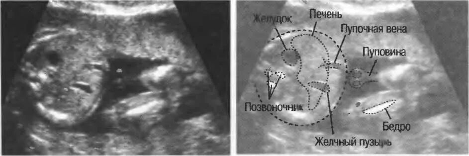Увеличена печень у новорожденного. Желчный пузырь у плода на УЗИ. Маленький желудок у плода на УЗИ. Патологии желудка у плода на УЗИ.