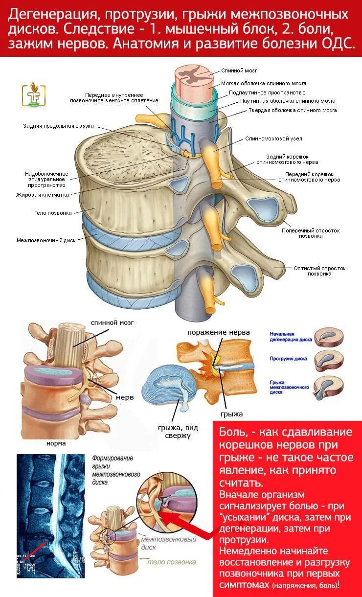 Болит ли протрузия. Что такое протрузия дисков позвоночника поясничного отдела. Протрузия дисков позвоночника что это такое симптомы. Грыжи и протрузии дисков позвоночника. Протрузия грыжа межпозвонковых дисков.