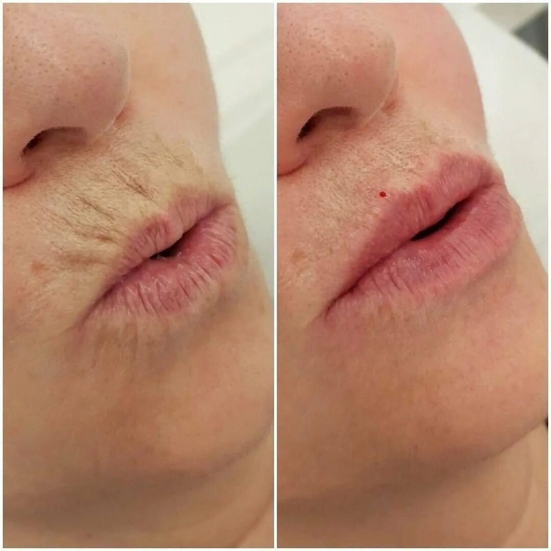 ботулотоксин в кисетные морщины. подбородочная морщина. ботокс над верхней губой. коррекция кисетных морщин. филлеры в кисетные морщины.