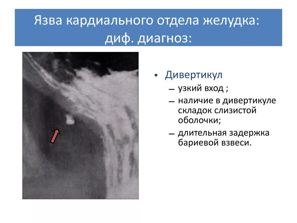 Кардиальная язва