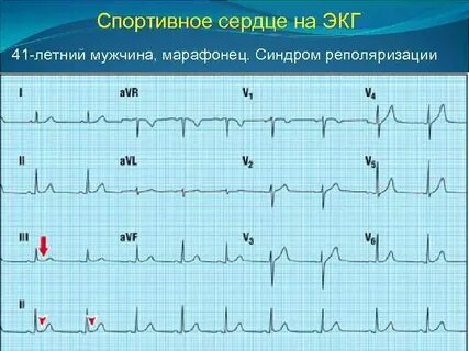 Экг у спортсменов