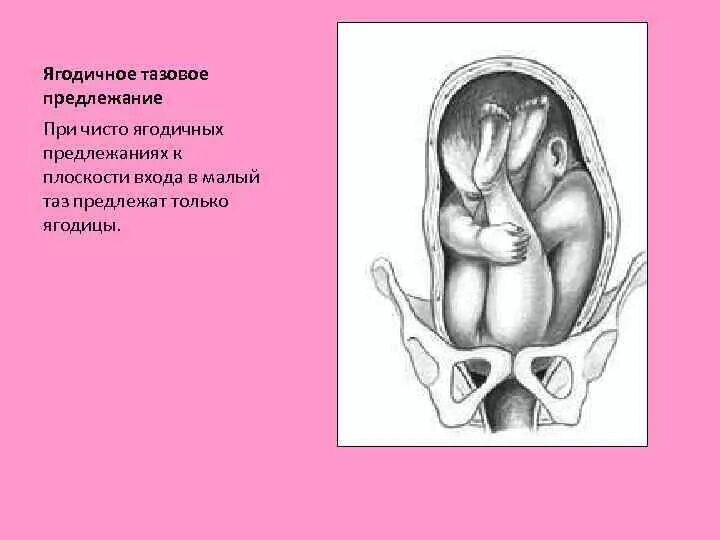 Предлежание плода 32 недели. Тазовое ягодичное предлежание продольное положение. Тазовое чисто ягодичное предлежание плода 32 недели. Ягодичное предлежание плода на 34 недели беременности. Тазовое ножное предлежание плода.