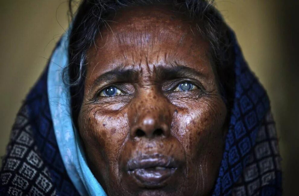 незрячий глаз