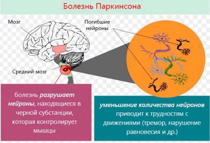 Синдромология болезни паркинсона. Причины развития паркинсонизма. Недостаток какого медиатора наблюдается при болезни паркинсона. Болезнь паркинсона. Паркинсонизм и болезнь паркинсона.