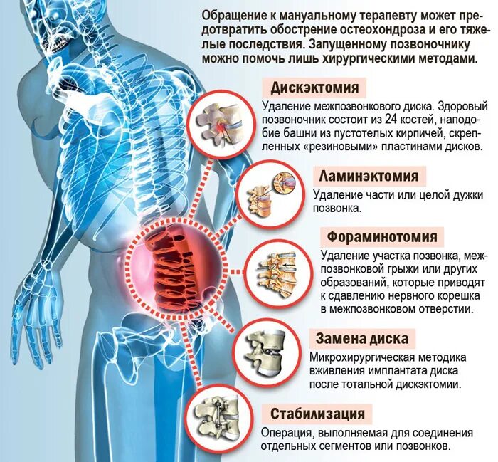 Схема терапии остеохондроза. Оостео хондрос шейнова одела. Симптомы остеохондроза 2 степени шейного отдела. Обострение шейного остеохондроза. Остеохондроз шейного отдела симптомы.
