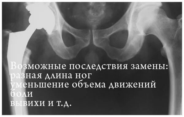 Велотренажер после эндопротезирования тазобедренного сустава. Ревизионное эндопротезирование тазобедренного сустава. Вывих эндопротеза тазобедренного сустава рентген. Боли после замены тбс. Коксартроз эндопротезирование тазобедренного сустава.