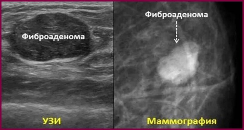 Округлые образования в молочной железе