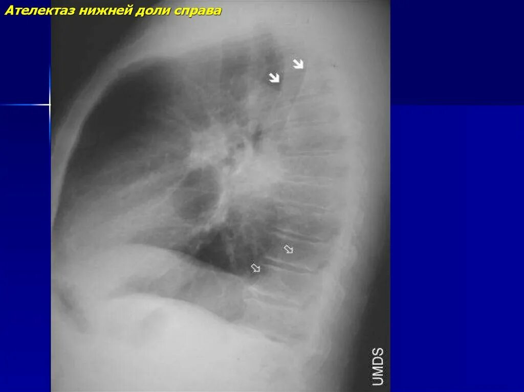 Рак нижней доли. Ателектаз средней доли справа рентген. Ателектаз верхней доли справа. Ателектаз верхней доли в боковой проекции. Ателектаз переднего сегмента верхней доли.