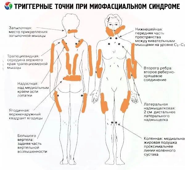 Психосоматика левая сторона у женщин. Миофасциальный синдром триггерные точки спины. Миофасциальные болевые триггерные точки тела человека. Болезненные точки при фибромиалгии. Болевые триггерные точки схема.