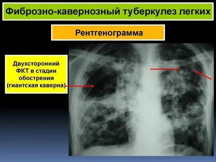 Каверна это